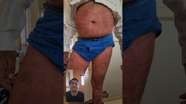 Steroid Abuse on Fungal infection ( Dr Bhutada Skin India) смотреть онлайн