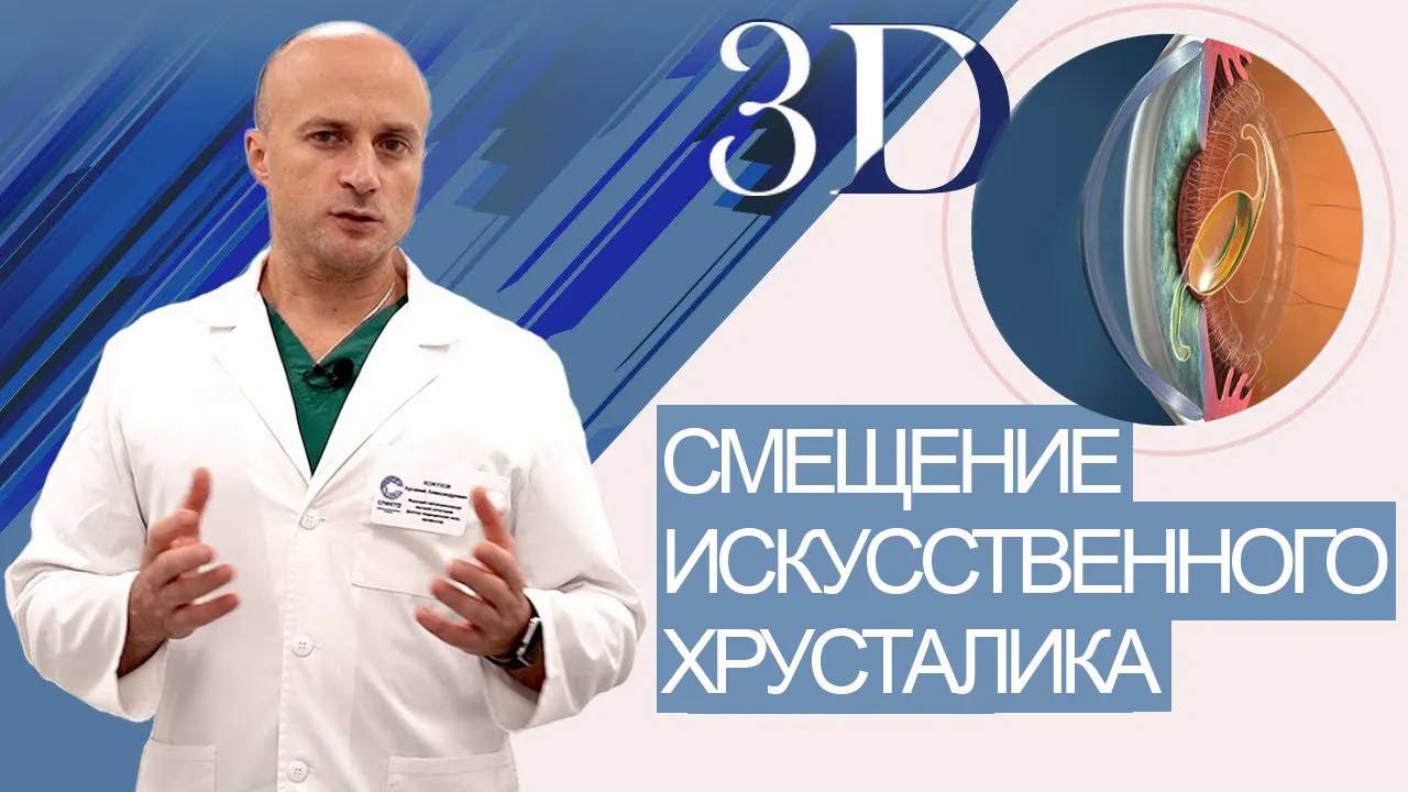 Дислокация ИОЛ (смещение искусственного хрусталика) смотреть онлайн