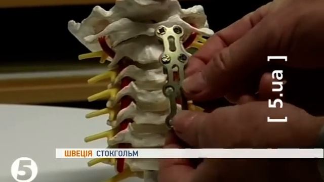 Клей для зрощування кісток. Швеція смотреть онлайн