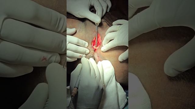 ANAL FISTULA AT THE ROOT OF THE SCROTUM- LONG BUT SUPERFICIAL TRACT смотреть онлайн