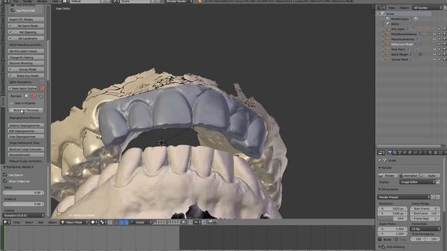 D3Splint WorkFlow: Anterior Deprogrammer смотреть онлайн