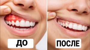 ПРОФИЛАКТИКА ЗАБОЛЕВАНИЙ ДЁСЕН.