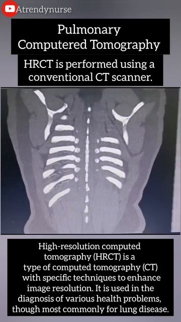 #assessment #pulmonary #chest 🩻High-resolution CT (HRCT) Of The Chest.🩻