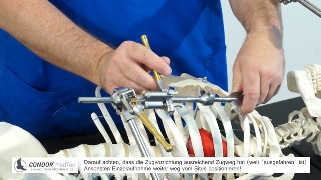 Minimally Invasive Direct Coronary Artery Bypass (MIDCAB) With Condor GoldLine®
