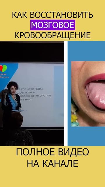 ВЕНОЗНЫЙ ЗАСТОЙ в голове — не игнорируйте первые симптомы! #shotrs #вены #болитголова смотреть онлайн