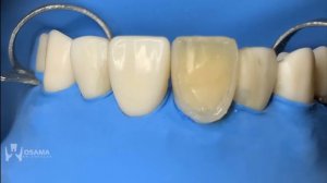 Этапы реставрации композитными винирами