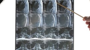 Грыжа позвоночника, делать ли операцию? Удалили грыжу, а боль осталась? Операция помогает?