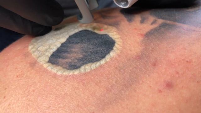 УДАЛЕНИЕ ТАТУИРОВКИ ЗА 20 СЕКУНД