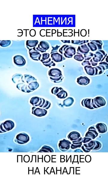 ПОСТОЯННАЯ СЛАБОСТЬ Это могут быть ПАРАЗИТЫ в вашем теле! #shotrs #гельминты #слабость смотреть онлайн