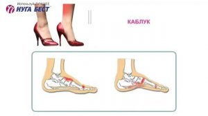 Доктор Голод В.М. о плоскостопии