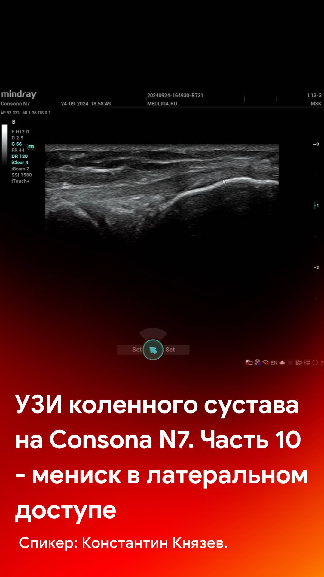 УЗИ коленного сустава на Mindray Consona N7. Часть 10 - мениск в латеральном доступе смотреть онлайн