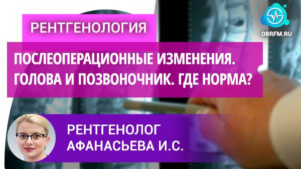 Рентгенолог Афанасьева И.С.: Послеоперационные изменения. Голова и позвоночник. Где норма? смотреть онлайн