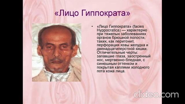 Пальцы Гиппократа, лицо Гиппократа смотреть онлайн