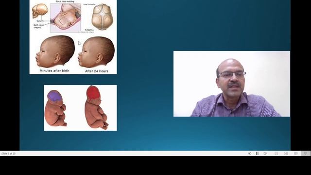 Moulding of the newborn's head shape. Abnormal head shape at delivery. Dr Sridhar Kalyanasundaram смотреть онлайн