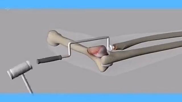 Closed (simple) fracture 🦴🦴🦴🦴🦴 смотреть онлайн