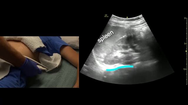 Kidney Ultrasound Scanning Technique смотреть онлайн