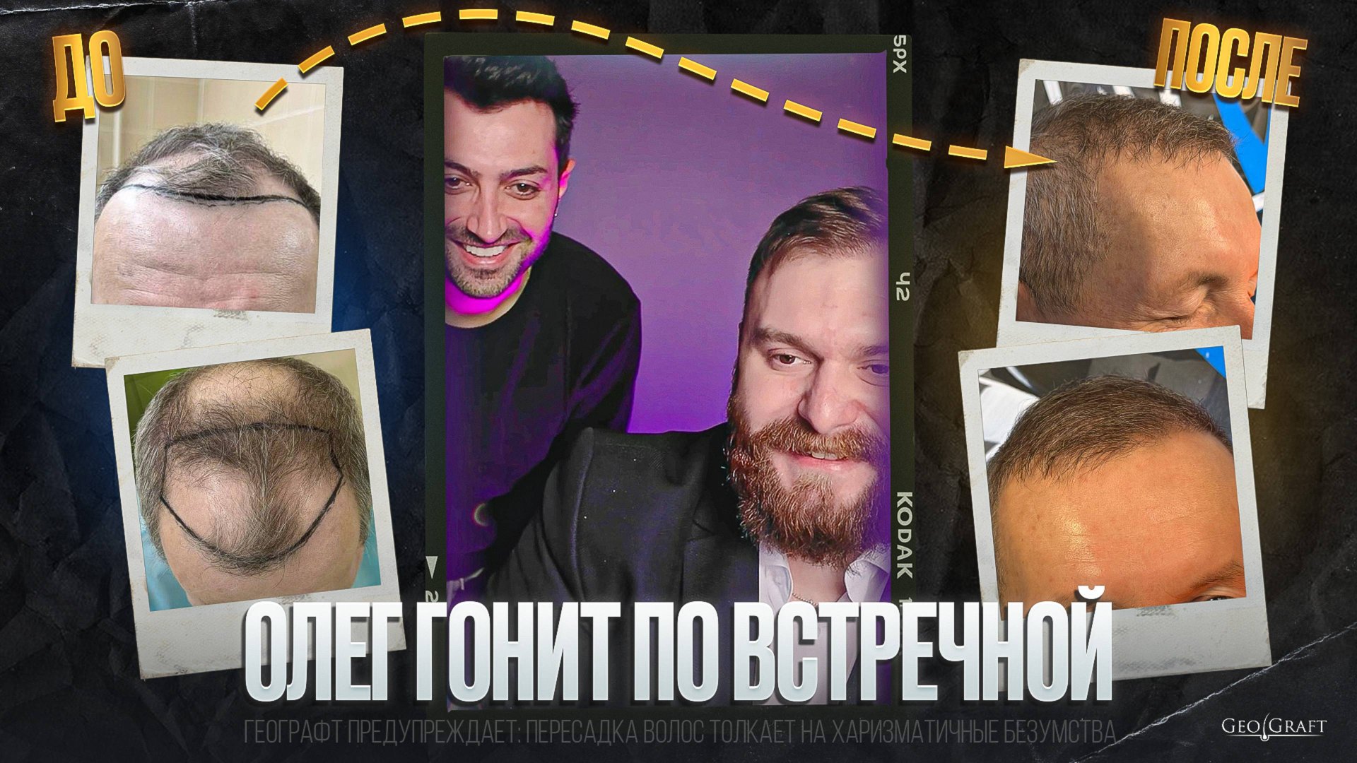 Олег гонит по встречной | Пересадка волос в Географт