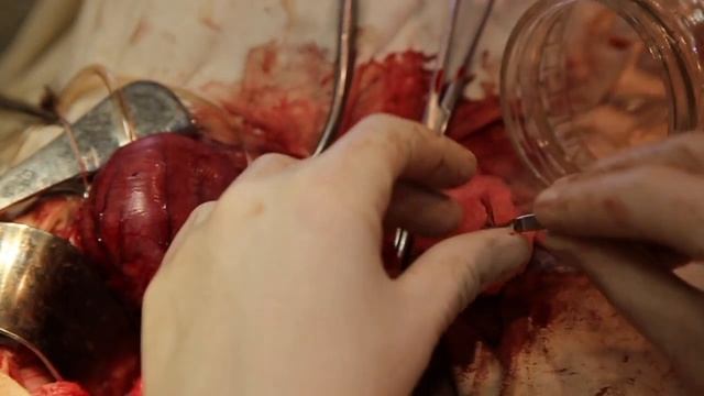 EXPERIMENTAL AORTOILIAC BYPASS / АОРТО-ПОДВЗДОШНОЕ ШУНТИРОВАНИЕ В ЭКСПЕРИМЕНТЕ смотреть онлайн