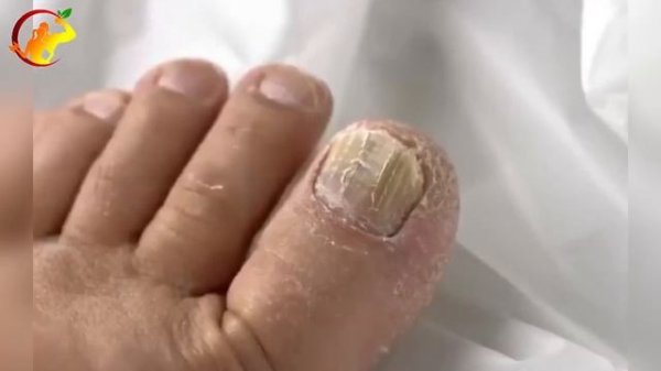 Димексид на стопы лечит даже... | Здоровый Организм #димексид