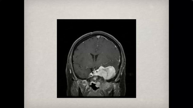 Imaging of Brain Extra-Axial tumors by Dr Mamourian HD 1080p смотреть онлайн