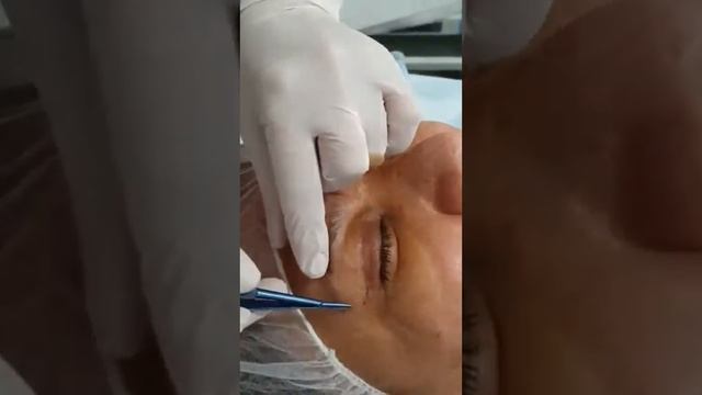 Блефаропластика. Пластический офтальмохирург Загидат Магомедовна. смотреть онлайн