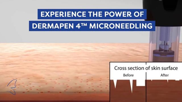 Do more with Dermapen 4 and MG-Collection смотреть онлайн