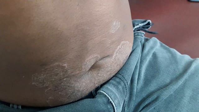 Tinea Corporis смотреть онлайн