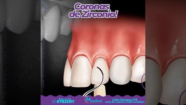 Qué son las CORONAS DE ZIRCONIO смотреть онлайн