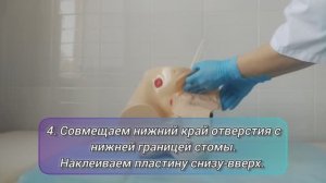 Техника замены калоприемника