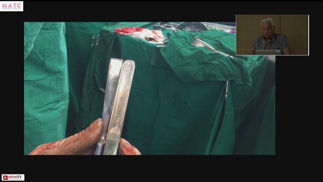 MATC 2023 : Angle Blade Plate: The forgotten Art of Surgery - Dr DD Tanna смотреть онлайн