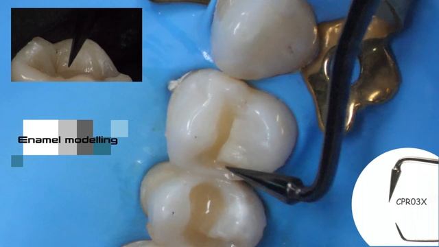 Aesthetic Direct Composite Restorations on molars | Deppeler | Dr. Brambilla смотреть онлайн