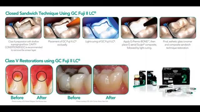 (Newmediro Dentalo) Fuji II LC / GC смотреть онлайн