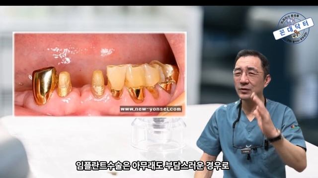치아 상실했을 때 임플란트 보다 브릿지 보철 치료가 더 좋은 경우들 6가지 смотреть онлайн