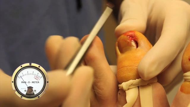 Ingrown Toenail Surgery- WARNING GROSS with Pain-O-Meter смотреть онлайн