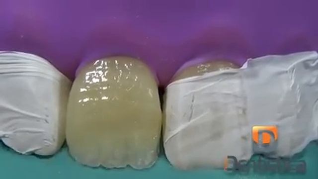 Restauração de dente anterior fraturado YouTube 5 смотреть онлайн