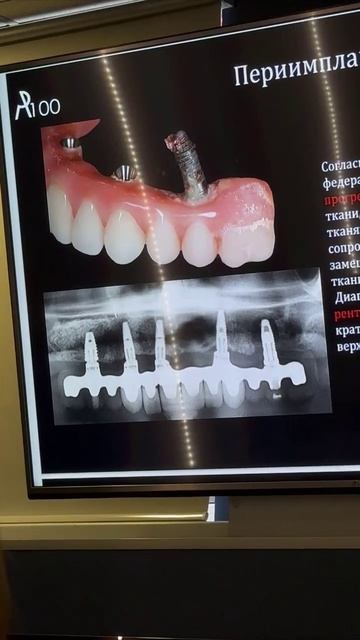 Курс Гигиенический протокол при реабилитации пациентов по концепции All-on-4®