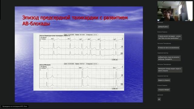 Вебинар 6. Нарушения ритма и проводимости смотреть онлайн