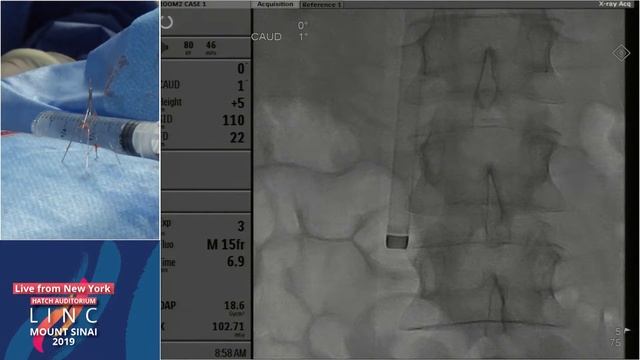(Hatch LC #1) - IVC Filter Retrieval - Dr. Lookstein смотреть онлайн