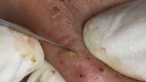 THE SUPER BLACKHEADS POPS | Suri Job 135