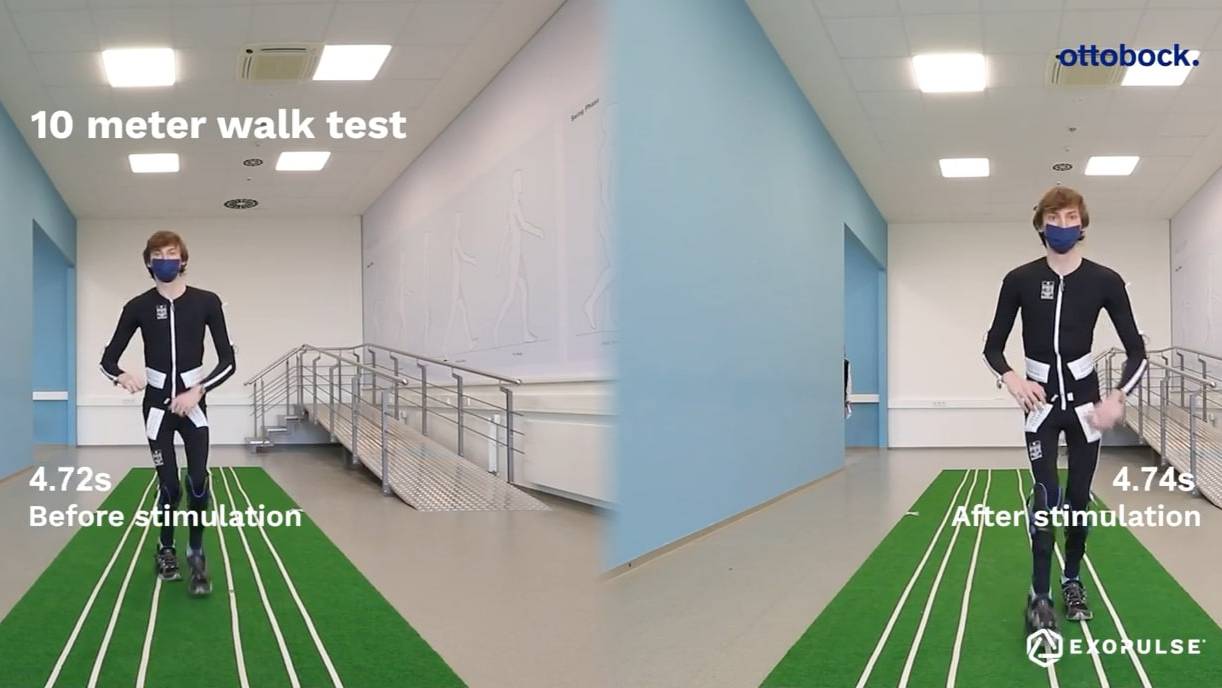 Max's Cerebral Palsy Related Spasticity Symptoms Before & After Wearing The Exopulse Mollii Suit