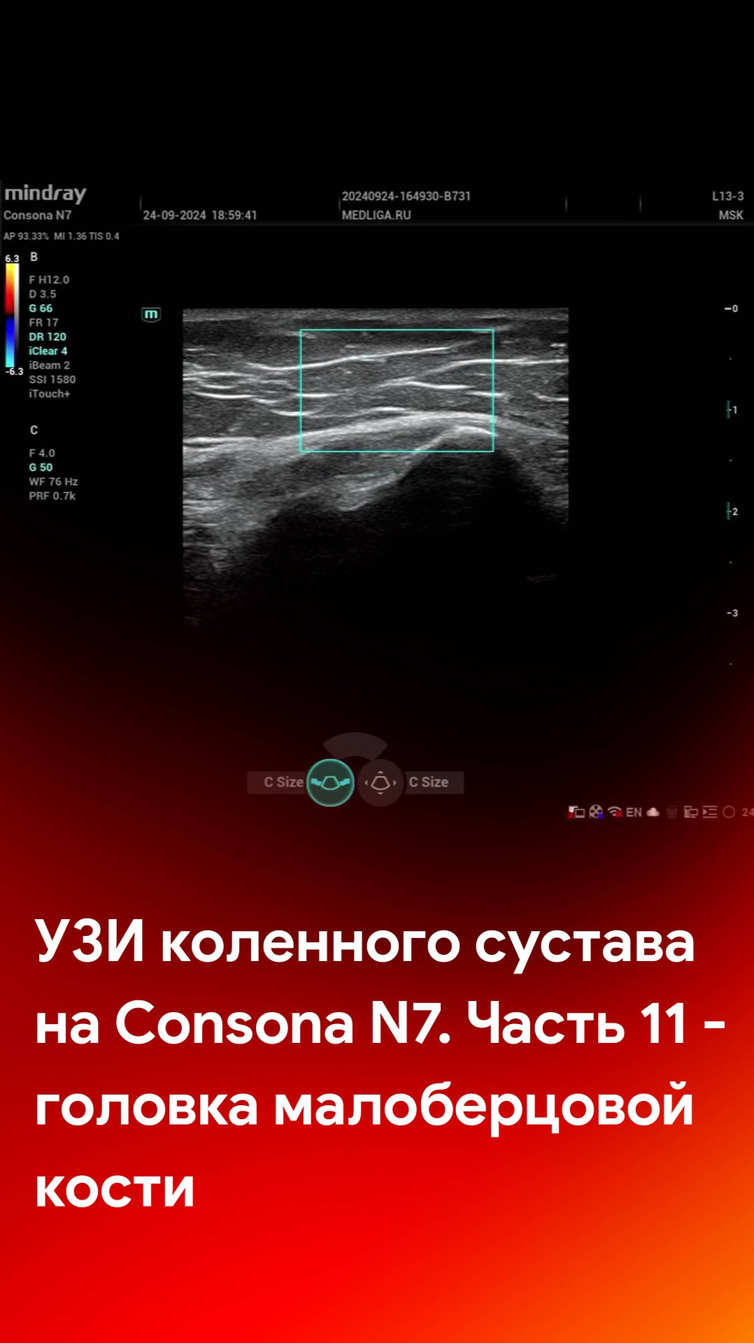 УЗИ коленного сустава на Mindray Consona N7. Часть 11 - головка малоберцовой кости смотреть онлайн