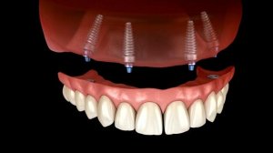 Все- на- 4 имплантантах