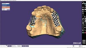 EXOCAD PARTIALCAD Моделировка Бюгельного протеза