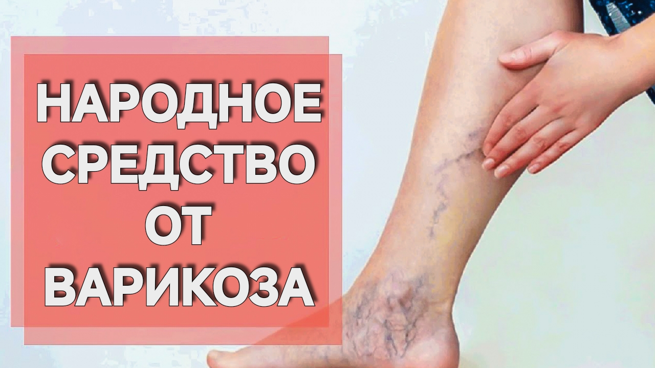 НАРОДНОЕ СРЕДСТВО ОТ ВАРИКОЗА. ОТЁЧНОСТИ СИНЮШНОСТИ.