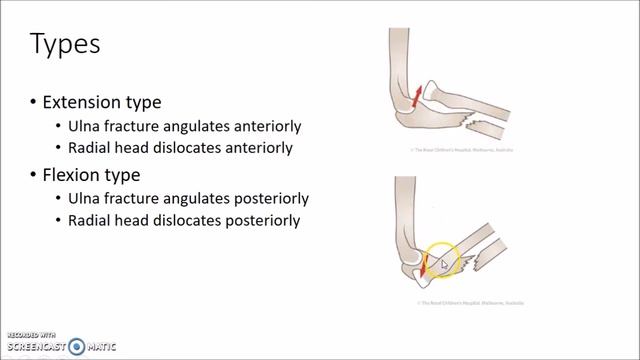 Monteggia Fracture Dislocation - Orthopedics for Medical Students смотреть онлайн