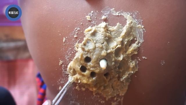 [ Thigh Worms ] Smart Way to Remove Worms On Dandruff Thigh #376 смотреть онлайн