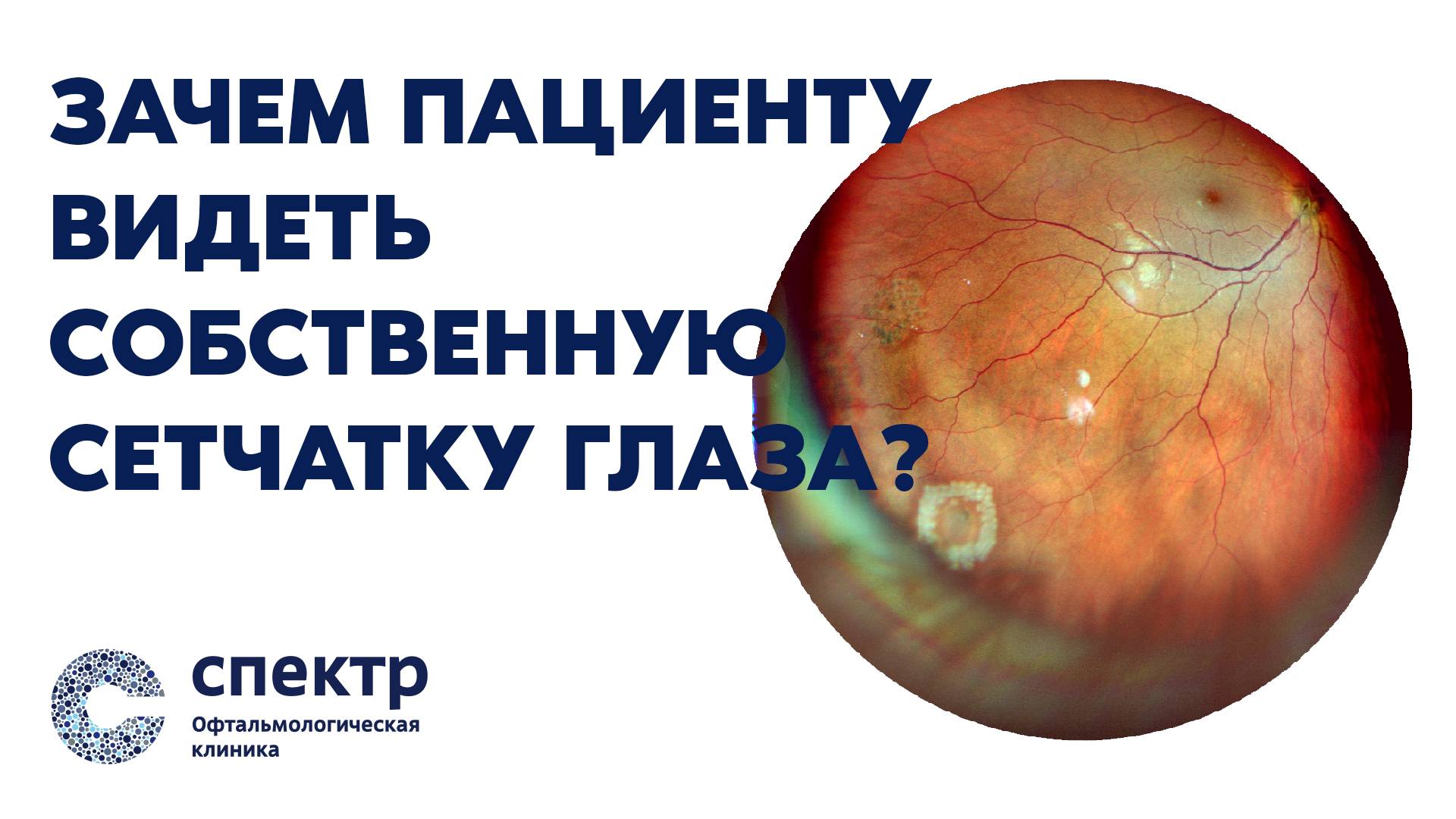 Как увидеть собственную сетчатку глаза? Расскажет врач-офтальмолог, к.м.н. Гудкова О.А. смотреть онлайн