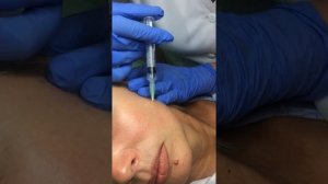 Мезотерапия и Биоревитализация. Мезотерапия лица. Практика