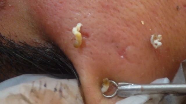 |Blackheads Extraction| |Blackheads Removal| |dr Pimple Popper Office|
