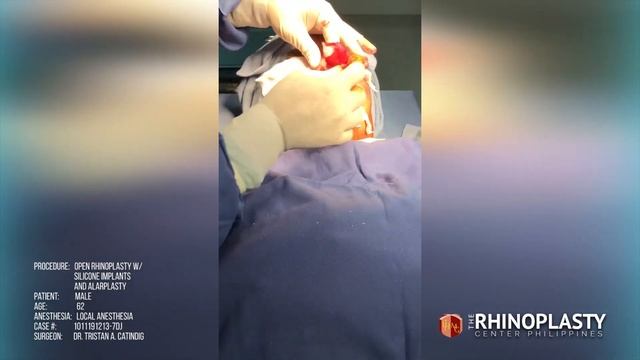 How It's Done: Open Rhino With Silicone, Tipplasty and Alarplasty (Male, 62, Under Local Anesthesia смотреть онлайн